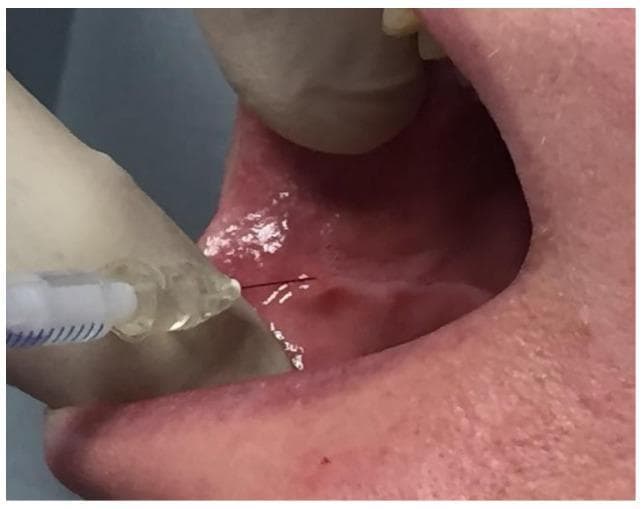 This clinical photograph demonstrates an intraoral endobuccal injection procedure targeting the buccinator muscle. A gloved hand is shown retracting the labial commissure to provide clear access to the jugal mucosa (inner cheek lining). A fine-gauge metallic needle, attached to a syringe containing clear fluid, is inserted perpendicular to a visible horizontal dental impression line on the mucosa. This landmark represents the plane of dental occlusion where the buccinator muscle is in close contact with the teeth. The injection site is located approximately 1 cm from the buccal commissure. The mucosa appears healthy, moist, and pink, with light reflection indicating a normal surface texture. This technique is typically utilized for the administration of botulinum toxin in the management of post-paralytic facial synkinesis or hypertonia. The procedure emphasizes anatomical precision for intramuscular delivery through the oral route to minimize external scarring and maximize therapeutic targeting of the middle third of the face.