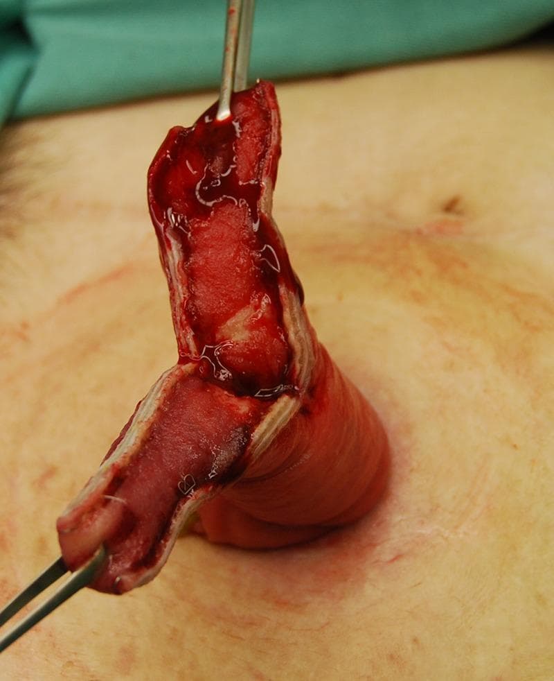 This clinical photograph captures an intraoperative view of a surgical procedure to revise a prolapsed stoma, likely an ileostomy. The image displays a segment of prolapsed, reddish, edematous intestinal tissue that has been longitudinally incised. Allis forceps are being utilized to grasp and elevate the cut edges of the intestinal wall, facilitating visualization of the lumen and the thickness of the bowel wall. The tissue appears hyperemic and fleshy with visible fresh blood on the surgical margins, consistent with a recent incision. The surrounding skin of the abdominal wall is visible, showing typical post-cleansing discoloration. This visual demonstrates a key step in the surgical management of stomal prolapse, where a linear stapler or manual resection is used to reduce the redundant, herniated bowel segment to a functional length, typically 4-5 cm above the skin level. The focus is on surgical technique and the anatomical manifestation of stomal complications in a clinical setting.