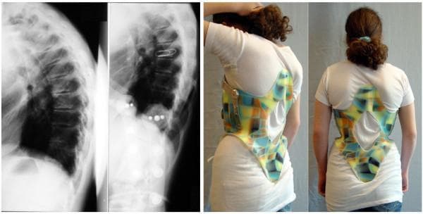 This composite image illustrates the conservative management of Scheuermann's kyphosis using a specialized spinal orthosis. The left panel consists of two lateral X-ray radiographs of the thoracic spine. The first X-ray demonstrates rigid thoracic kyphosis with characteristic vertebral wedging and increased sagittal curvature. The second X-ray shows the patient in a Kyphologic™ brace, exhibiting significant in-brace correction of the curvature (>20°) and improved vertebral alignment. The right panel contains two clinical photographs (posterolateral and posterior views) of a patient wearing the low-profile Kyphologic™ brace over a white T-shirt. The brace is a rigid thoracolumbosacral orthosis (TLSO) featuring a colorful geometric pattern, significant posterior cutouts for comfort and ventilation, and a side-closure mechanism using straps. The design employs a 3-point pressure system to redress thoracic hyperkyphosis while minimizing material bulk to improve patient compliance and quality of life.