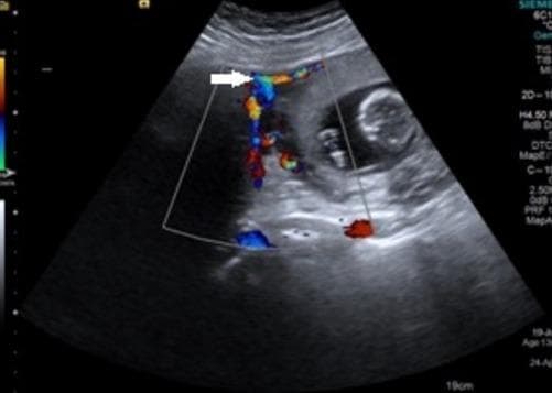 This diagnostic image is a transabdominal color Doppler ultrasound in a sagittal plane, depicting a gravid uterus at approximately 13-14 weeks of gestation. Key anatomical features include a visible fetus within the intrauterine cavity and a large, well-defined, relatively hypoechoic mass adjacent to the uterine fundus. A critical diagnostic sign is the presence of a 'bridging vessel,' indicated by a white arrow. The color Doppler overlay demonstrates prominent vascular flow (red and blue signals) traveling through this bridging vessel from the uterine fundal wall to the mass. In obstetric imaging, the bridging vessel sign is a classic sonographic marker used to differentiate a pedunculated subserosal uterine leiomyoma (fibroid) from an adnexal or ovarian mass. The presence of this vessel confirms the uterine origin of the lesion by visualizing the vascular supply derived from the uterine arteries. This clinical visualization is essential for surgical planning and distinguishing between benign uterine myomas and potential ovarian malignancies during pregnancy.