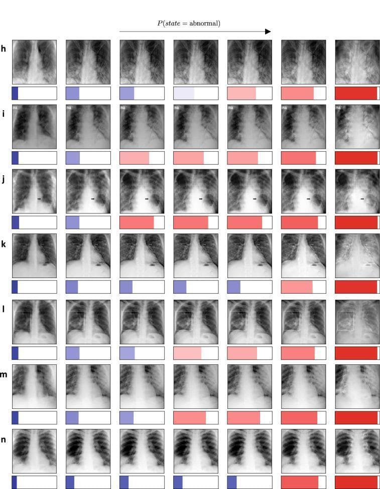 This Comparison Chart illustrates diagnosis-based counterfactual explanations for chest X-ray (CXR) analysis using the TraCE framework. The image is organized into seven horizontal rows (labeled hβn), each representing a unique clinical case. Within each row, a progression of seven CXRs shows a gradual transition from a 'normal' state (left) to an increasingly 'abnormal' state (right). Visually, this progression is marked by the introduction of patchy opacities, infiltrates, and consolidations within the lung fields, simulating the appearance of pneumonia-related pathology. Below each X-ray is a horizontal bar chart indicating the predictive model's confidence level, shifting from blue (low likelihood of abnormality) to red (high likelihood of abnormality). Key landmarks such as the cardiac silhouette, rib cage, and diaphragmatic contours are maintained across each sequence to demonstrate that the model manipulates only relevant diagnostic features rather than changing the anatomical structure. This infographic serves as an educational tool for understanding how deep learning models identify clinical signatures of lung disease.
