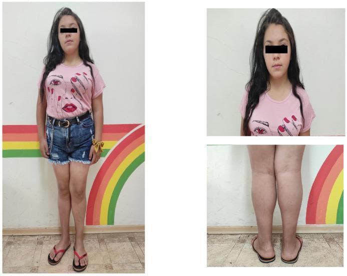 This clinical photograph set shows a pediatric female patient following one year of L-thyroxine replacement therapy for Kocher-Debre-Semelaigne syndrome (KDSS), a rare manifestation of juvenile hypothyroidism. The image consists of a full-body standing view, a close-up of the face, and a detailed posterior-anterior view of the lower legs. Visually, the patient demonstrates a significant reduction in overall body mass and waist circumference compared to baseline. A key clinical feature documented is the resolution of muscular pseudohypertrophy, particularly in the bilateral gastrocnemius muscles (calves), which now appear proportional rather than pathologically enlarged. The facial view shows a softening of previously 'rough' features, with less prominent macroglossia and thick lips. The images illustrate the physical reversibility of the myopathic and metabolic symptoms of severe hypothyroidism through hormonal optimization. These visual findings are essential for medical students studying endocrine myopathies and the physical manifestations of childhood thyroid deficiency.