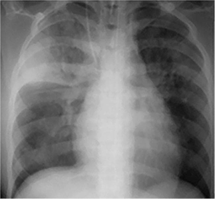 Frontal chest radiograph demonstrating significant bilateral pulmonary opacities. A prominent, dense area of lobar consolidation is visible in the right upper lobe, sharply demarcated inferiorly by the horizontal (minor) fissure. Within this consolidated region, branching lucencies representing air bronchograms are evident, indicating alveolar space filling with patent airways. Additionally, there is patchy, multifocal consolidation involving the right lower lung zone and the left upper and mid-lung zones, particularly in the perihilar distributions. An endotracheal tube is visualized with its tip in the mid-trachea. These radiographic findings are characteristic of severe inflammatory or infectious processes such as acute pneumonia or pulmonary tuberculosis. The image serves as an educational example of lobar vs. patchy consolidation and the utility of the silhouette sign and minor fissure in anatomical localization of lung pathology.