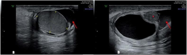 Two-panel diagnostic ultrasonography of the right scrotum demonstrating scrotal anatomy and pathology. Figure (a) displays a grayscale sagittal view of the right testis, showing normal, homogeneous echogenicity and regular borders. A red arrow indicates a small, anechoic fluid collection surrounding the testis, characteristic of a mild right-sided hydrocele. Figure (b) reveals a large, well-circumscribed cystic lesion adjacent to the epididymal head. This cyst is marked with a red asterisk (*) and exhibits thick walls with internal heterogeneity. A second red arrow in panel (b) highlights the concomitant hydrocele fluid. These findings are consistent with an epididymal cyst (spermatocele) which, in this clinical context, demonstrated torsion. This diagnostic imaging serves as an educational example of scrotal ultrasound interpretation for differentiating normal testicular parenchyma from epididymal pathologies and secondary fluid accumulations.