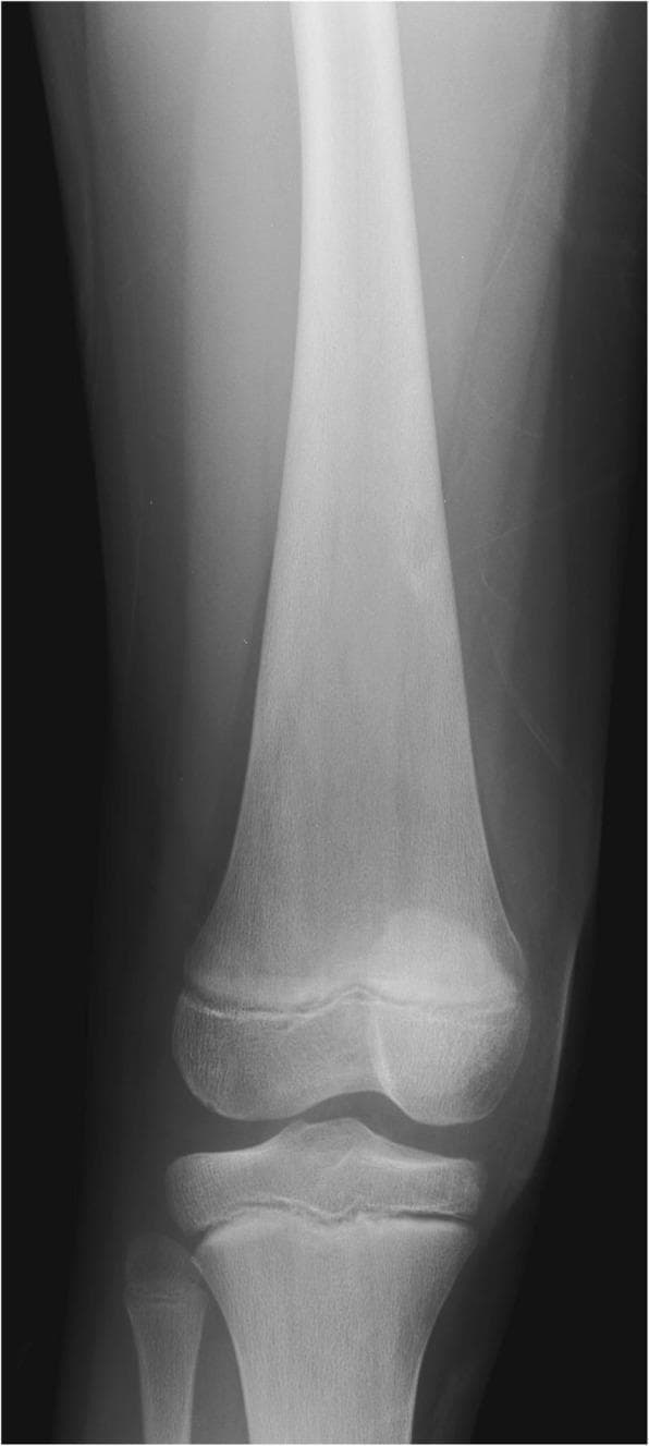 This diagnostic image is a frontal (anteroposterior) radiograph of the right knee of a 12-year-old male. The primary clinical finding is a prominent 'Erlenmeyer flask deformity' of the distal femur. This morphology is characterized by significant widening and expansion of the distal femoral diaphysis and metaphysis, where the bone fails to undergo normal cortical remodeling and tapering. The expanded metaphysis appears disproportionately large relative to the femoral epiphysis. The radiodensity of the distal femur is comparable to the proximal tibia, though the fibula shows slightly higher radiodensity. This characteristic bony deformity is a classic skeletal manifestation of Gaucher disease, resulting from the accumulation of Gaucher cells within the marrow cavity causing medullary expansion. The image serves as a key educational example of metabolic bone disease and storage disorders affecting the appendicular skeleton in pediatric patients.