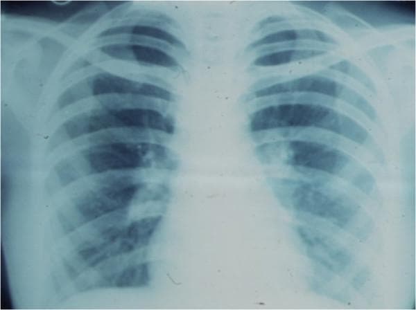 This diagnostic image is an anteroposterior chest X-ray demonstrating a classic presentation of bilateral hilar lymphadenopathy. The primary finding is the symmetrical enlargement of the hilar regions, appearing as lobulated, increased-density masses where the major bronchi and pulmonary vessels enter the lung parenchyma. This 'potato-node' appearance is a hallmark of pulmonary sarcoidosis. The lung fields are generally clear without obvious parenchymal infiltrates or consolidation, though the hilar margins are ill-defined due to the lymphatic enlargement. The mediastinal borders are slightly widened, but the cardiac silhouette and diaphragmatic contours remain distinguishable. The ribcage and clavicles are visualized and provide anatomical orientation. Clinically, this imaging is characteristic of Stage I sarcoidosis, often used to evaluate systemic granulomatous disease in both radiology and internal medicine education.