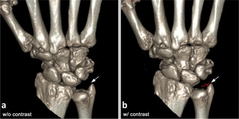 This diagnostic image shows side-by-side three-dimensional (3D) volume-rendered reconstructions from dual-energy computed tomography (DECT) scans of a human hand and wrist. The comparison illustrates the detection of monosodium urate (MSU) crystals, which are characteristic of gout. Panel (a), labeled 'w/o contrast', shows the anatomical structure of the carpal bones and distal radius and ulna before intravenous iodinated contrast administration; at the ulnocarpal joint (indicated by a white arrow), no specific pathology is highlighted. Panel (b), labeled 'w/ contrast', demonstrates the same anatomical region after the administration of iodinated contrast medium. In this enhanced scan, small red-colored voxels (arrow) appear in the ulnocarpal joint space, representing the successful DECT identification of MSU deposits or tophi. The image demonstrates a clinical scenario where intravenous contrast can influence the visualization and material decomposition algorithm's ability to identify uric acid crystals in a patient with gout. The educational focus is on the diagnostic imaging of rheumatological conditions using advanced CT modalities.