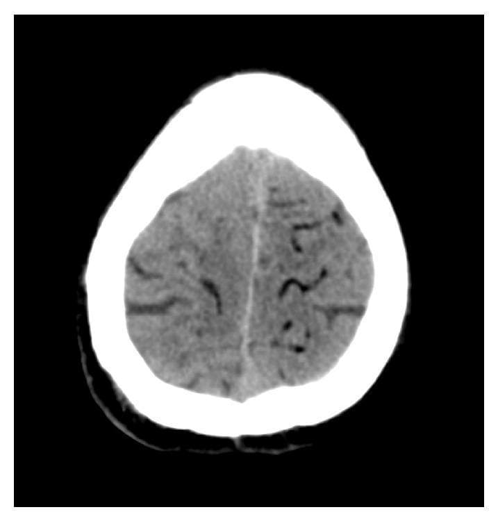 This diagnostic image is a non-contrast axial CT scan of the brain demonstrating a cerebral air embolism. The image shows multiple, distinctive hypodense (dark) serpentiform and curvilinear structures located primarily in the subcortical regions of both cerebral hemispheres. These low-density areas represent air within the cerebral vasculature, exhibiting negative Hounsfield units characteristic of intravascular gas. The distribution follows a gyral pattern just beneath the cortex, which is a classic radiographic sign of arterial air embolism. The clinical context involves a post-procedural complication following a percutaneous lung biopsy, where air entered the systemic circulation and reached the cerebral arteries. This finding is critical for diagnosing acute neurological deficits following thoracic interventions. The educational focus is on the recognition of iatrogenic vascular complications and the characteristic 'air-on-brain' appearance on computed tomography.