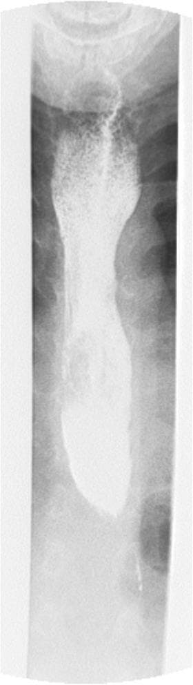 This diagnostic image is a barium swallow fluoroscopy (X-ray radiography) of the upper gastrointestinal tract, specifically the esophagus. The image reveals classic radiographic findings of achalasia. There is marked dilation of the esophageal body (megaesophagus), which appears as a widened, radiopaque column due to the retention of barium contrast. At the distal end, the esophagus exhibits a smooth, symmetrical tapering that terminates in a narrow, 'bird's beak' or 'rat-tail' appearance at the level of the lower esophageal sphincter (LES). This tapering signifies failure of the LES to relax, causing functional obstruction and a delay in contrast passage into the stomach. The clinical significance of this finding is the confirmation of achalasia, often associated with symptoms like dysphagia, regurgitation, and failure to thrive. The image provides a primary educational example of esophageal motility disorders within the field of gastroenterology and pediatric radiology.