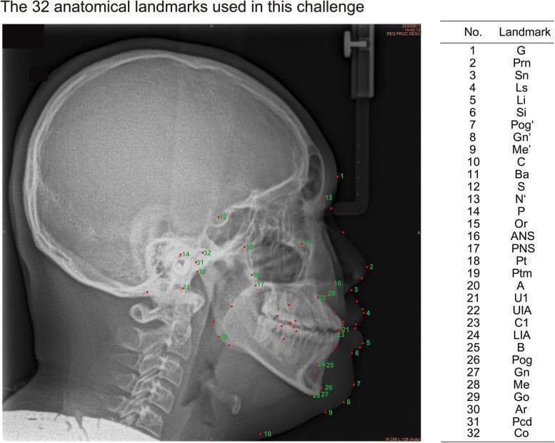 This diagnostic image is a lateral cephalometric radiograph, a specialized X-ray used in orthodontics and maxillofacial surgery to analyze skeletal, dental, and soft tissue relationships of the human head in profile. The radiograph displays clear views of the cranium, facial bones, mandible, upper cervical vertebrae, and the soft tissue outline of the nose, lips, and chin. Overlaid on the image are 32 numbered red dots representing standardized anatomical landmarks. These points are distributed across the cranial base (e.g., Sella, Nasion), midface (e.g., Anterior Nasal Spine, Subspinale), mandible (e.g., Menton, Gonion), dental structures (incisor positions), and facial soft tissues (e.g., Pronasale, Labrale). Adjacent to the radiograph is a reference table linking each number to its corresponding medical abbreviation, such as ANS, PNS, and Pog. This educational visual demonstrates the precise localization required for cephalometric tracing and clinical assessment of craniofacial morphology.