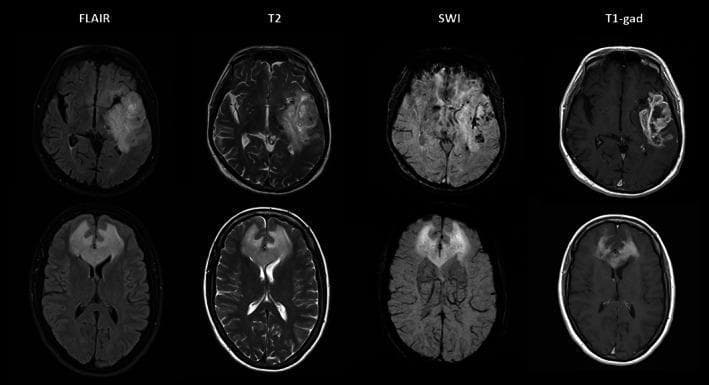 A comparative diagnostic MRI panel presenting two different cases of brain neoplasms across four imaging modalities: FLAIR, T2-weighted, Susceptibility-Weighted Imaging (SWI), and T1-gadolinium enhanced (T1-gad). The top row illustrates a high-grade glioma in the left temporal lobe. The FLAIR and T2 images show a hyperintense mass with surrounding edema. Crucially, the SWI sequence reveals prominent dark spots known as intratumoral susceptibility signals (ITSS), indicative of microhemorrhage and neovascularization, while the T1-gad sequence shows a heterogeneous, peripheral enhancement pattern typical of high-grade gliomas. The bottom row demonstrates a primary CNS lymphoma located in the frontal lobes/corpus callosum. While the FLAIR and T2 images show hyperintensity, the SWI sequence is notably clear of ITSS. The T1-gad image exhibits marked, homogeneous enhancement, a classic feature that distinguishes lymphoma from the more heterogeneous appearance of a glioma. This panel serves as an educational tool for neuroradiology, highlighting how SWI sequences can differentiate tumor types based on the presence or absence of internal vascular complexity and blood products.