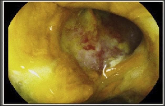 This endoscopic image shows a large, 'punched-out' peptic ulcer located at the junction of the first and second portions of the duodenum. The ulcer is approximately 2 cm in diameter and features sharply demarcated, well-defined borders. The base of the ulcer is covered with a heterogeneous layer of yellowish-white necrotic debris and fibrin, interspersed with multiple erythematous spots and punctate stigmata of recent hemorrhage, suggesting active inflammation or recent bleeding. The surrounding duodenal mucosa appears edematous and mildly hyperemic compared to healthy tissue, with a loss of clear vascular architecture near the ulcer's edge. This clinical finding is characteristic of H. pylori-induced duodenal ulceration. The image serves as a diagnostic tool for identifying gastrointestinal bleeding sources and assessing the severity of mucosal damage in the upper digestive tract.