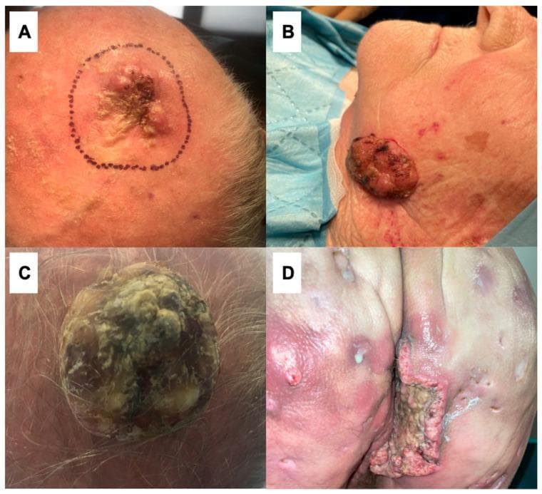 This composite of four clinical photographs (A-D) demonstrates various morphological presentations of giant cutaneous squamous cell carcinoma (cSCC), a malignant keratinocytic neoplasm. (A) Shows a large, irregular, ulcerated plaque on the scalp, marked with a surgical margin, featuring central crusting and perilesional erythema. (B) Displays a prominent, exophytic, reddish-brown nodular mass on the left cheek with a friable, glistening surface and associated actinic damage on surrounding skin. (C) Illustrates a massive, dome-shaped verrucous tumor on the scalp with a hyperkeratotic, multi-lobulated surface containing yellowish-tan and gray keratinous debris. (D) Presents an extensive, deep ulcerated cSCC on the buttock occurring in the setting of chronic hidradenitis suppurativa (HS). This lesion shows irregular, everted borders and a necrotic base, surrounded by inflamed tissue with scarring, sinus tracts, and pustules characteristic of Hurley stage III HS. These cases highlight the clinical diversity of cSCC, its association with chronic inflammatory conditions, and the potential for significant local tissue destruction in advanced stages.