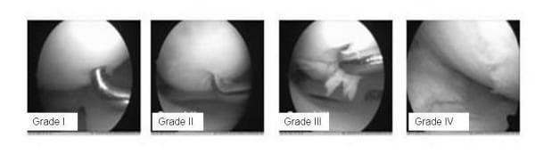 A series of four arthroscopic clinical photographs demonstrating the progression of cartilage damage in the knee joint, classified according to the International Cartilage Repair Society (ICRS) grading system. Grade I shows superficial softening or minor surface indentation, often assessed via an arthroscopic probe. Grade II depicts a partial-thickness defect with visible surface irregularities or fissures extending less than 50% of the cartilage depth. Grade III illustrates a more severe, deep defect penetrating more than 50% of the cartilage thickness, showing clear fibrillation and tissue disruption. Grade IV represents full-thickness cartilage loss, exposing the underlying subchondral bone with evident pitting or ulceration. These images serve as a diagnostic reference for orthopedic surgery and rheumatology, highlighting the transition from minor chondromalacia to advanced osteoarthritis within various knee compartments such as the patellofemoral and femoro-tibial joints.