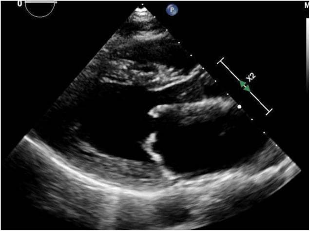 This diagnostic image is a transthoracic echocardiogram in the parasternal long-axis (PLAX) view, demonstrating classic features of mitral stenosis secondary to rheumatic heart disease. The image shows the left ventricle (LV), left atrium (LA), and the aortic root. Key pathology is localized to the mitral valve, where both the anterior and posterior leaflets exhibit significant thickening and increased echogenicity. The leaflets demonstrate restricted diastolic opening, resulting in a narrow valve orifice. The anterior mitral valve leaflet shows a characteristic 'doming' appearance (hockey-stick deformity), which is pathognomonic for rheumatic involvement. The LA appears moderately dilated, a common consequence of chronic mitral stenosis. This educational visual is intended for cardiology and radiology students to illustrate the valvular morphology and mechanical obstruction characteristic of rheumatic mitral valve disease, emphasizing the role of non-invasive ultrasound imaging in assessing valvular heart disease.