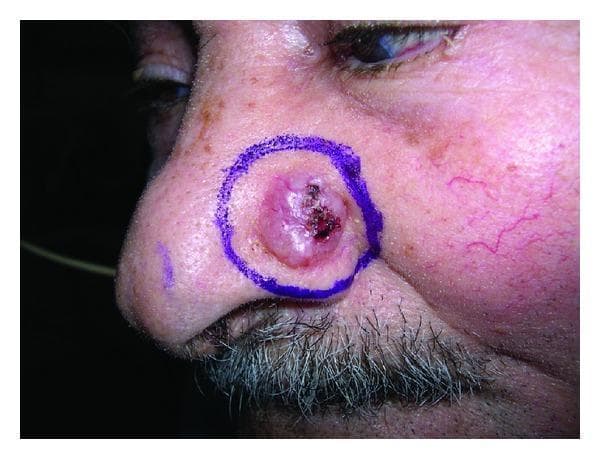 This clinical photograph displays a nodular basal cell carcinoma located on the right side of a patient's nose. The lesion is a well-circumscribed, oval-shaped, pinkish-flesh-colored nodule approximately 1.5 cm in diameter, circled in purple marker for clinical identification. Key diagnostic features include a distinct pearly, translucent surface and classic rolled borders. A central focal ulceration with hemorrhagic crusting is evident, indicating a 'rodent ulcer' presentation. Arborescent telangiectasias (fine, dilated blood vessels) are visible on the surface of the nodule and extending onto the adjacent skin of the cheek. The surrounding skin shows signs of chronic actinic damage, including solar lentigines. This image serves as a classic educational example of the most common subtype of basal cell carcinoma, highlighting the importance of recognizing texture, vascularity, and border morphology in dermatological diagnosis.