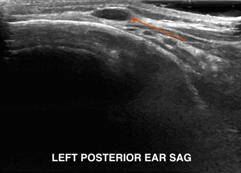 A diagnostic ultrasound image in the sagittal plane capturing the left posterior auricular region. The image demonstrates a well-defined, ovoid, hypoechoic structure (highlighted by an orange arrow) located in the subcutaneous tissue layer, consistent with posterior auricular lymphadenopathy. The structure exhibits distinct borders from the surrounding hyper-echogenic connective and fatty tissues. Notable acoustic features include posterior acoustic enhancement, indicated by increased brightness distal to the lesion, which suggests the presence of fluid or low-density contents within the node. The imaging serves to evaluate localized scalp or ear swelling and differentiates between reactive lymph nodes, cysts, or potential abscesses in a clinical setting involving regional inflammation or infestation.