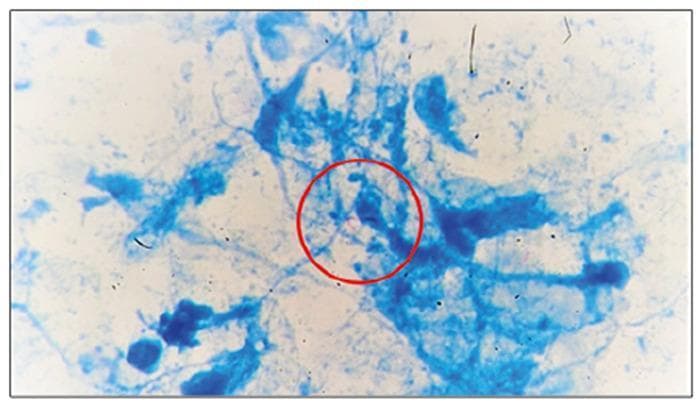 This diagnostic image is a high-power light microscopy field showing a histopathological sample stained with Ziehl-Neelsen or a similar acid-fast stain. The background consists of blue-stained cellular debris, fibrous tissue, and inflammatory infiltrates from a pericardial biopsy. Centrally highlighted within a red circular annotation are several bright red or pink, rod-shaped microorganisms. These characteristics are pathognomonic for acid-fast bacilli (AFB), specifically Mycobacterium tuberculosis. The visual demonstrates the diagnostic findings of tuberculous pericarditis, where the pathogen is directly visualized within the pericardial tissue despite a non-granulomatous histological appearance. This slide serves as an educational example of infectious pathology and the clinical utility of specialized staining in identifying extracellular pathogens in extrapulmonary tuberculosis.