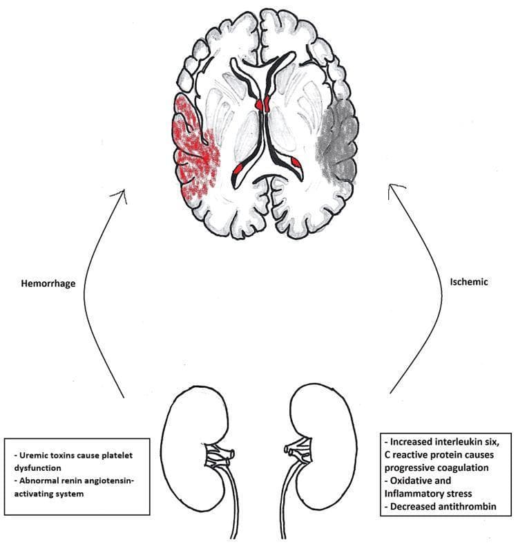 A medical pathophysiology diagram illustrating the bidirectional mechanisms linking chronic kidney disease (CKD) to stroke. The top of the diagram features a cross-sectional anatomical illustration of the brain. The left hemisphere depicts an area of red discoloration labeled 'Hemorrhage,' while the right hemisphere shows a gray-shaded region labeled 'Ischemic.' Below, a pair of kidneys is illustrated, connected to the brain pathology by curved arrows. The left arrow connects the kidney to hemorrhagic stroke, with an adjacent text box outlining contributing factors: uremic toxins causing platelet dysfunction and an abnormal renin-angiotensin-activating system. The right arrow connects the kidney to ischemic stroke, with a text box detailing mechanisms including increased Interleukin-6 (IL-6) and C-reactive protein (CRP) leading to progressive coagulation, oxidative and inflammatory stress, and decreased antithrombin. This educational graphic demonstrates how renal dysfunction promotes both pro-thrombotic and pro-hemorrhagic states, significantly increasing stroke risk in CKD and end-stage renal disease (ESRD) patients.