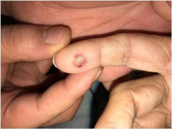 This clinical photograph displays a solitary skin lesion on the distal phalanx of a human ring finger. The lesion is a well-circumscribed, circular bulla (blister) approximately 5-8 mm in diameter. It features a centrally opaque, whitish roof, indicating potential epidermal necrosis or serous fluid accumulation. The blister is bordered by a distinct erythematous halo, suggesting localized inflammation. The surrounding skin appears normal with typical age-related wrinkling, particularly at the interphalangeal joints. In a clinical context, this lesion illustrates a phototoxic skin burn resulting from photodynamic therapy (PDT) and subsequent light exposure from a pulse oximeter probe. It serves as an educational example of iatrogenic skin injury and photosensitivity reactions related to talaporfin sodium. The educational focus is on perioperative dermatology and the importance of shielding photosensitized patients from specific light wavelengths used in routine monitoring equipment.