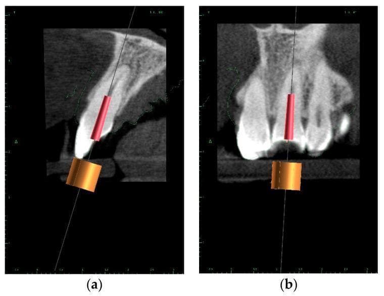 This diagnostic image displays a Cone Beam Computed Tomography (CBCT) scan used for guided endodontic planning, shown in (a) sagittal and (b) coronal cross-sections. The visual demonstrates the digital mapping of a virtual implant (red cylinder) within a maxillary tooth, representing the path for a planned access drill. A thin, continuous vertical line indicates the intended access trajectory from the occlusal/incisal surface toward the root canal system. An orange cylindrical guide sleeve is positioned externally to represent the teeth-supported surgical template. The educational focus is on 'Guided Endodontics' and the preservation of pericervical dentin, illustrated by the lighter shaded volume of tooth structure surrounding the planned drill path. This imaging modality is used to treat pulp canal calcification by accurately localizing obliterated canals while minimizing the risk of perforation. The content is intended for advanced dental students or endodontic specialists learning computer-aided design and manufacturing (CAD/CAM) workflows in clinical dentistry.