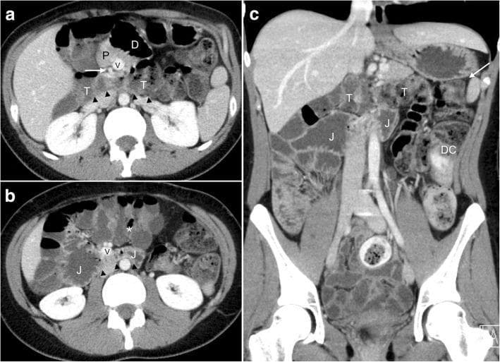 This contrast-enhanced abdominal CT study in axial (a, b) and coronal reformatted (c) views demonstrates a rare variant of midgut malrotation known as reversed rotation. Key diagnostic features include a 'retro-arterial' course of the transverse colon (T) and proximal jejunum (J), which are seen passing posterior to the superior mesenteric artery (SMA) and vein (SMV), effectively sandwiched between these mesenteric vessels and the aorta. In image 'a', at the level of the pancreas (P), the duodenum (D) crosses anterior (ventral) to the mesenteric vessels, contrary to normal anatomy. There is a notable inversion of the mesenteric vessels, with the SMV (V) situated to the left of the SMA (white arrow), often associated with malrotation. Aplasia of the pancreatic uncinate process is also visible. Image 'b' shows the cecum and ileocecal valve (*) in an aberrant midline position. The coronal view (c) confirms the normal position of the hindgut components, including the left colic flexure (white arrow) and descending colon (DC), while highlighting the abnormal posterior positioning of the midgut structures relative to the mesenteric root.