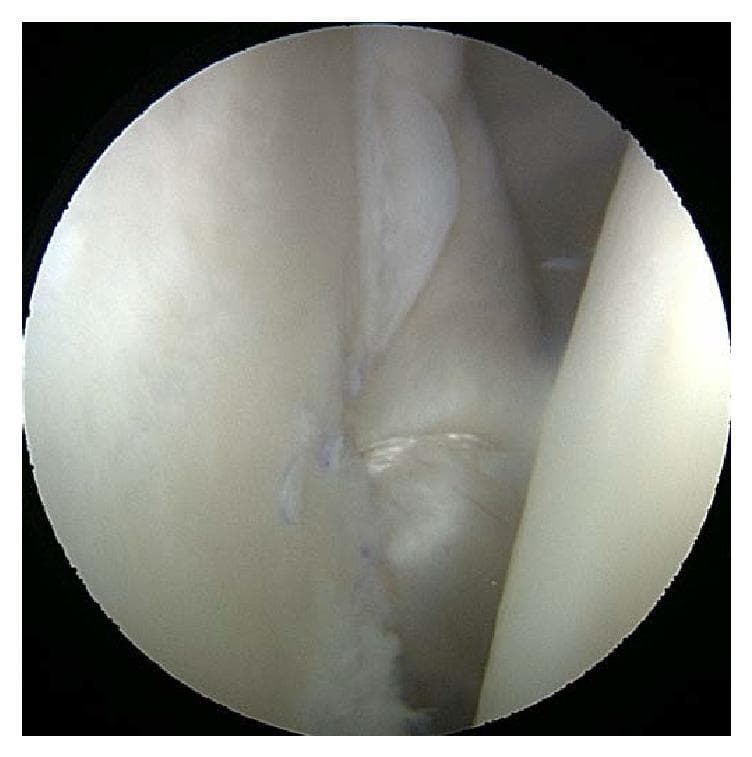 Intraoperative arthroscopic clinical photograph demonstrating the final appearance of a shoulder joint following an anterior and posterior capsular shift with Bankart repair. The image showcases the glenohumeral joint space where light-colored, creamy-white soft tissue, primarily the joint capsule and labrum, appears smooth and glistening. Key surgical features include blue synthetic sutures embedded within the tissue margins, indicating the successful plication and stabilization of the redundant capsule. The fold of tissue in the upper right quadrant reflects the tightened capsular volume intended to address multidirectional instability. This visual is significant for illustrating orthopedic surgical techniques for recurrent shoulder dislocation and instability, specifically highlighting tissue approximation and the structural outcomes of a capsulolabral reconstruction.