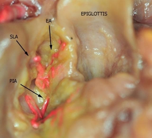 This clinical photograph displays a superior view of a fresh-frozen human cadaver larynx prepared for anatomical study. The dissection shows the epiglottis and the paraglottic space, with the overlying fat tissue partially removed to reveal the underlying vasculature. The arteries have been injected with a bright red bicomponent silicone to enhance visualization and contrast against the yellowish, translucent paraglottic fat and pale mucosal surfaces. Specific vascular structures are labeled: the Superior Laryngeal Artery (SLA), the Epiglottic Artery (EA), and the Postero-Inferior Artery (PIA). This image serves as an educational resource for understanding laryngeal surgical anatomy, particularly the arterial distribution and anastomotic networks within the paraglottic space, which is critical for minimizing hemorrhagic risk during laryngological procedures.