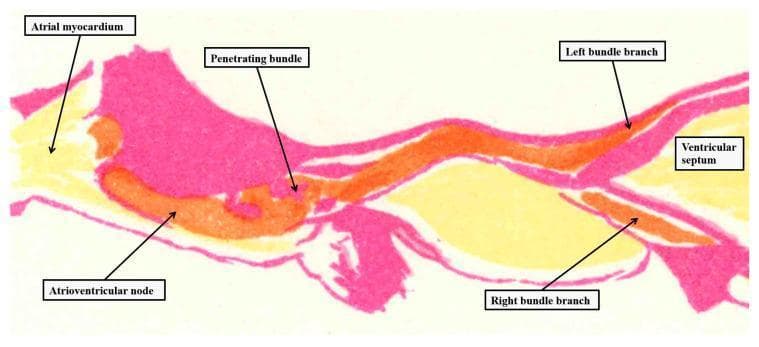 This medical illustration is a color-coded anatomical diagram depicting the atrioventricular (AV) conduction axis of the heart, based on a historical plate by Tawara and reoriented for attitudinal clarity. The diagram utilizes a longitudinal cross-sectional view to map the electrical pathway through the cardiac tissues. The atrial chambers and atrial myocardium are positioned on the left, while the ventricular septum and ventricular chambers are on the right. Key structures are differentiated by color: orange indicates the conduction axis, yellow represents the working myocardium, and purple (or dark pink) denotes the insulating fibrous tissues of the AV junction. Labeled components of the conduction system include the atrioventricular node, the penetrating bundle, and the bifurcation into the left bundle branch and right bundle branch. The image highlights the anatomical relationship between the specialized conducting cells and the adjacent insulating planes, demonstrating how the electrical impulse traverses from the atria to the ventricles while being sequestered from non-conducting myocardial masses.