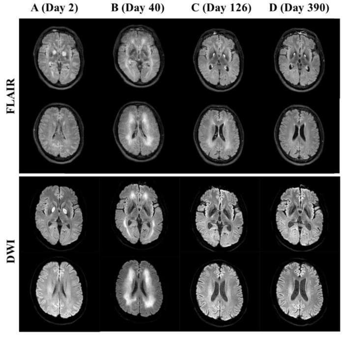 This diagnostic image grid displays serial axial brain magnetic resonance imaging (MRI) of a patient following carbon monoxide (CO) poisoning. The grid compares two modalities—Fluid-Attenuated Inversion Recovery (FLAIR) and Diffusion-Weighted Imaging (DWI)—across four time points: Day 2 (A), Day 40 (B), Day 126 (C), and Day 390 (D).
Key findings include:
- Day 2: Symmetric hyperintense lesions are prominent in the bilateral globus pallidus, characteristic of acute CO-induced necrosis.
- Day 40: Development of extensive, symmetric hyperintensities in the subcortical and periventricular white matter, representing delayed neuropsychiatric syndrome (DNS) or leukoencephalopathy.
- Day 126: Significant interval reduction in the intensity and extent of the white matter lesions.
- Day 390: Resolution of the white matter abnormalities, while the bilateral globus pallidus lesions persist as chronic findings.
The comparison demonstrates the temporal evolution of CO-induced brain injury, showing the transition from acute basal ganglia damage to delayed white matter involvement and eventual partial radiological recovery. This series is an educational example of neurotoxicology and metabolic encephalopathy.