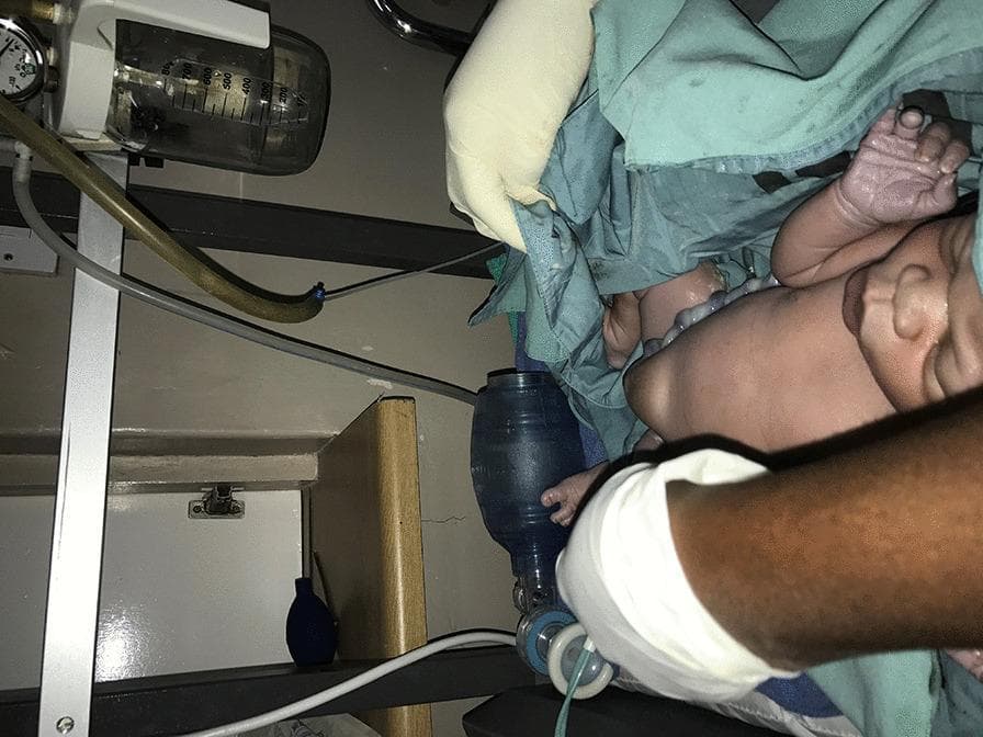 Clinical photograph of a full-term newborn in a delivery or neonatal resuscitation setting, positioned on a warming table. The infant displays a prominent soft tissue protrusion at the umbilicus, consistent with a congenital umbilical hernia. The newborn's skin tone appears light with visible peripheral cyanosis (acrocyanosis) of the hands and feet, which are slightly purplish in color. Essential neonatal resuscitation equipment is visible in the frame, including a blue manual resuscitation bag (Ambu bag) with a clear mask held by a healthcare provider's gloved hand, prepared for positive pressure ventilation. In the background, medical suction apparatus is visible, comprising a graduated collection canister and a pressure gauge mounted on a stand with tubing. This procedural image illustrates the immediate postnatal assessment and management of an infant born with an abdominal wall defect in a clinical environment.