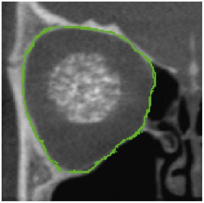 This diagnostic image is a coronal cross-section of the human bony orbit obtained via Cone Beam Computed Tomography (CBCT). The image demonstrates the internal anatomy of the orbital cavity, showing the heterogeneous density of the surrounding facial bones in varying shades of gray. A prominent green digital trace outlines the bony orbital border, providing a clear demarcation of the orbital rim and walls. This automated or semi-automated segmentation encompasses the orbital volume and highlights specific anatomical contours, including the superior and inferior orbital margins. The trace follows the complex geometry of the bone, including slight indentations that correspond to the locations of neurovascular passages, such as the superior or inferior orbital fissures and foramina. Centrally, a blurred hyperdense region represents the soft tissue contents of the orbit. This visualization is used in clinical workflows for orbital volume measurement, assessment of post-traumatic deformities, and planning for orbital implants or reconstructive surgery.