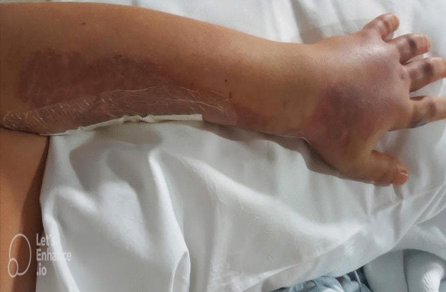 Clinical photograph of a human left upper extremity demonstrating significant postoperative skin changes following a fasciotomy for compartment syndrome. The forearm, dorsum of the hand, and fingers exhibit diffuse, pronounced edema, resulting in a tense, swollen appearance. Extensive ecchymotic patches are visible, particularly on the hand and fingers, with colors ranging from deep reddish-purple to blue-gray, indicating subcutaneous hemorrhage. A large, erythematous, and possibly necrotic-appearing lesion is present on the dorsal aspect of the proximal forearm, consistent with the site of a jellyfish sting and subsequent tissue reaction. A transparent occlusive dressing is applied over a surgical incision site on the medial aspect of the forearm. The image serves as a clinical example of the local manifestations of jellyfish venom-induced compartment syndrome and the immediate postoperative appearance after limb-saving surgical intervention.