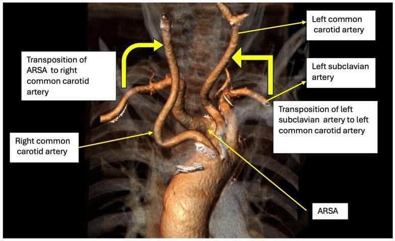 This diagnostic image is a 3D CT angiography reconstruction of the aortic arch and supra-aortic vessels, illustrating a treatment plan for Dysphagia Lusoria. The primary pathology shown is an Aberrant Right Subclavian Artery (ARSA), which originates as the last branch of the aortic arch and takes a retroesophageal course. The diagram annotates a surgical strategy for bilateral carotid-to-subclavian transposition. Key anatomical labels include the Right Common Carotid Artery and Left Common Carotid Artery, with yellow arrows indicating the proposed transposition of both the ARSA and the Left Subclavian Artery to their respective ipsilateral common carotid arteries. This vascular reconstruction highlights the relationship between the aberrant vessel and the esophageal compression site. The image serves as a clinical algorithm for hybrid surgical management, focusing on the debranching and revascularization of the upper extremities to relieve symptomatic compression while maintaining distal perfusion. Target audience includes vascular surgeons and radiologists studying congenital aortic arch anomalies.