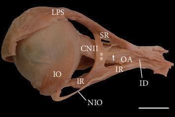 This clinical photograph displays a lateral view of a dissected human left orbit, demonstrating a rare anatomical variation of the extraocular muscles. The primary finding is a variant muscular slip (marked with double asterisks) forming a bridge between the superior rectus (SR) and the inferior rectus (IR) muscles. This bridge is located lateral to the optic nerve (CNII). Additionally, a specific tendinous band (marked with a white arrow) is visible arising from this muscular bridge and attaching posteriorly to the common tendinous ring (Annulus of Zinn). Key neurovascular and muscular structures identified include the levator palpebrae superioris (LPS), the inferior oblique (IO), the inferior branch of the oculomotor nerve (ID), and the nerve to the inferior oblique (NIO). Notably, the NIO is shown piercing the fibers of the inferior rectus. The lateral rectus muscle has been removed to expose these deep orbital structures. This specimen illustrates potential sources of diagnostic confusion in orbital imaging and relevant anatomy for ophthalmologic surgery and strabismus management.