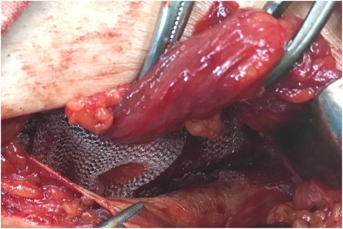 This intraoperative clinical photograph demonstrates a Lichtenstein-style inguinal hernia repair (hernioplasty). The visual focus is on the reinforcement of the posterior wall of the inguinal canal. A silver-gray, woven polypropylene mesh is visible, positioned deep to the spermatic cord. The cord, appearing as a reddish-pink, tubular, fleshy structure, is being retracted superiorly and laterally by surgical instruments to allow for the proper placement of the mesh. The mesh is shown sutured to the surrounding musculoskeletal landmarks, including the conjoined tendon superiorly and the reflection of the inguinal ligament inferiorly. A central aperture is created in the mesh to accommodate the passage of the spermatic cord through the internal ring. This image serves as an educational reference for surgical residents and medical students studying the second stage of open inguinal hernia mesh repair, emphasizing anatomical orientation and the relationship between prosthetic material and the cord structures.