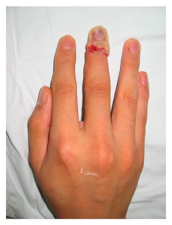 A clinical photograph of a patient's hand following distal digit replantation surgery. The image focuses on the middle finger, which has undergone a replantation procedure at the distal interphalangeal (DIP) joint or zone I level. A circumferential surgical incision is visible, secured with sutures, and showing signs of raw, disrupted tissue and minor blood staining at the site of anastomosis. The distal tip of the finger exhibits significant signs of vascular compromise, characterized by a dusky, cyanotic, and bluish discoloration visible beneath the nail plate and across the fingertip skin. This visual presentation is indicative of arterial insufficiency or venous congestion, suggesting impaired peripheral perfusion to the replanted segment. The surrounding digits and the dorsal aspect of the hand appear otherwise normal in color and morphology. This image serves as a clinical example of postoperative monitoring for vascular patency in microsurgery and digit salvage procedures.