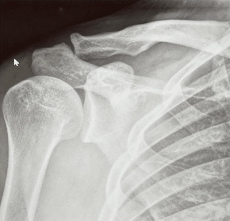 Anterior-posterior (AP) diagnostic X-ray of the right shoulder girdle, demonstrating the musculoskeletal anatomy of the glenohumeral and acromioclavicular joints. The image provides a clear view of the proximal humerus, including the humeral head and greater tuberosity, the glenoid fossa of the scapula, the acromion, the coracoid process, and the lateral aspect of the clavicle. The cortical margins are sharp and continuous with no evidence of acute fracture, cortical disruption, or periosteal reaction. The glenohumeral joint space is preserved, with the humeral head properly centered within the glenoid, ruling out dislocation. The acromioclavicular (AC) joint also appears within normal limits without widening or elevation. The trabecular bone density and distribution appear unremarkable for an adult patient. In a clinical context involving soft tissue injuries like pectoralis major ruptures, this radiographic study serves as a baseline to exclude associated bony pathology, such as avulsion fractures or shoulder instability. This imaging is characteristic for orthopedic evaluation in emergency and sports medicine settings.