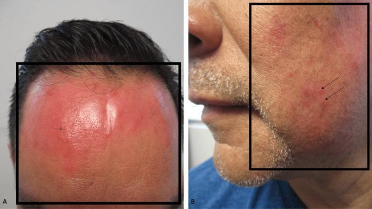 Clinical photograph of a male patient in his late 50s presenting with topical corticosteroid-induced dermatitis. The image is divided into two panels. Panel A (frontal view) shows the forehead with a large, confluent, erythematous macular patch within a black outlined area. The skin appears bright red and inflamed, resembling the clinical presentation of a superficial or first-degree thermal burn. Panel B (lateral view) displays the left cheek featuring macular erythema and small, randomly distributed pustules, as indicated by black arrows within the highlighted region. These features are characteristic of steroid-induced rosacea-like dermatitis following the repetitive application of high-potency corticosteroids (betamethasone 0.05% cream) to facial skin. The educational focus is on the adverse cutaneous effects of potent topical steroids and their ability to mimic acute inflammatory conditions or burns.