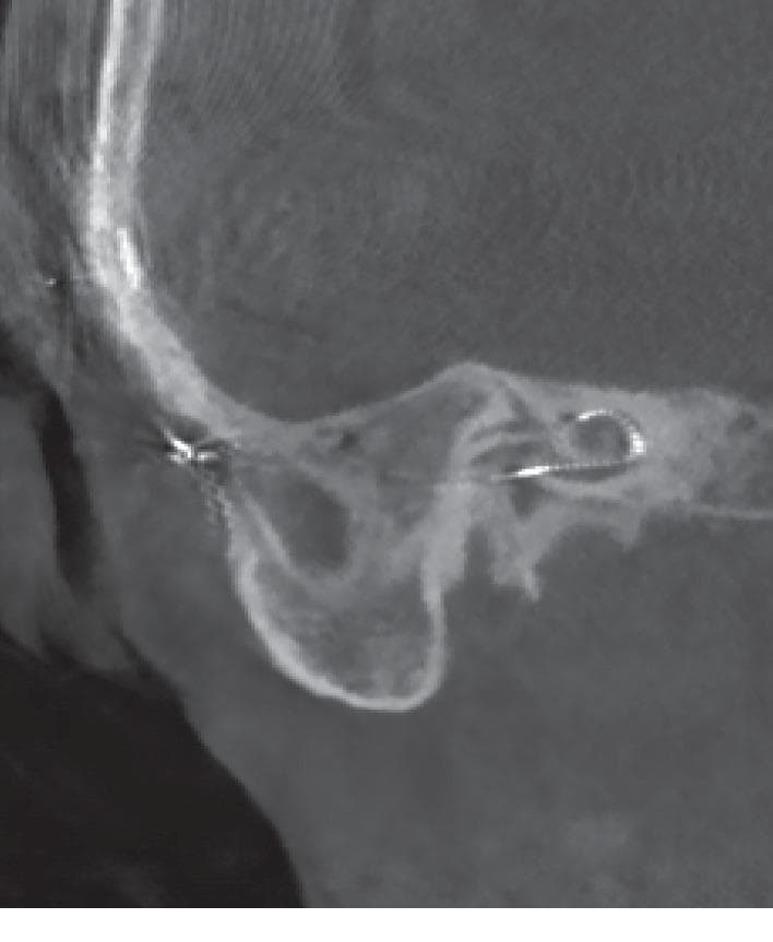 This diagnostic image is a post-operative Computed Tomography (CT) scan of the right temporal bone, focused on the inner ear anatomy. The image demonstrates a cochlear implant in situ, following a primary implantation procedure. The electrode array is clearly visible as a curved, hyperdense (radiopaque) metallic structure positioned within the fluid-filled spaces of the cochlea. Specifically, the electrode is shown following the spiral trajectory of the basal turn, with an insertion depth of approximately 290 degrees. Key anatomical landmarks visible include the bony labyrinth of the cochlea, the mastoid process with its air cells, and the outline of the tympanic cavity. The image serves as an educational example of post-surgical verification for cochlear implant positioning, highlighting the spatial relationship between the prosthetic electrode and the delicate spiral architecture of the inner ear. It illustrates the clinical standard for assessing electrode array placement and ensuring correct anatomical orientation within the cochlear duct.