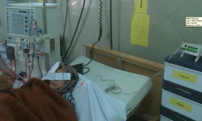 A clinical photograph depicting a patient undergoing hemodialysis in a hospital setting. The patient is lying in a semi-fowler's position on a clinical bed, with their eyes covered for privacy. To the left of the bed, a large hemodialysis machine is visible, featuring a complex arrangement of blood tubing, a dialyzer (artificial kidney), and a control panel with monitoring displays. A blood pressure cuff is applied to the patient's arm to monitor cardiovascular stability during the procedure. Positioned on a storage unit to the right is a specialized Relative Blood Volume (RBV) monitor, a research-oriented electronic device with a digital LCD, which is connected via sensors to the dialysis circuit. This setup illustrates the clinical integration of non-invasive optical sensors used to monitor hemoconcentration and fluid shifts in real-time to prevent complications like intradialytic hypotension. The background shows clinical infrastructure, including wall-mounted medical gas lines and labeled equipment drawers in a sterilized environment.