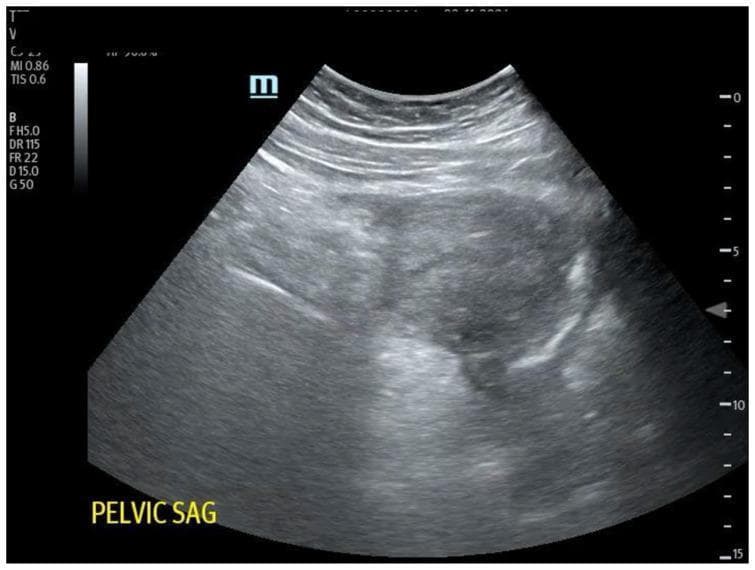 This diagnostic image is a transabdominal ultrasound of the female pelvic region, presented in a sagittal orientation as indicated by the label 'PELVIC SAG'. The ultrasound sector shows the anatomy at a depth of up to 15 cm. The central focus is a heterogeneous, largely hypoechoic to isoechoic mass or structure, potentially representing the uterus or a pelvic adnexal finding. Above this central structure, well-defined hyperechoic linear layers represent the abdominal wall and subcutaneous tissues. The internal texture of the pelvic organs appears mottled with mixed echogenicity, including darker hypoechoic areas that may suggest fluid collections or soft tissue interfaces. Clinical context suggests this image is used for educational purposes to demonstrate pelvic sonography, orientation of the endocavitary or transabdominal probe, and identification of significant pathology such as potential free fluid in cases of ectopic pregnancy or hemorrhagic shock.