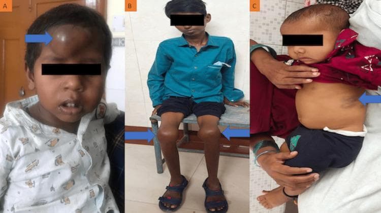 A composite of three clinical photographs (A, B, C) illustrating the varied clinical manifestations of haemophilia in pediatric patients. Image A shows a five-year-old child with a prominent, dome-shaped, tense swelling on the central forehead, identified as an extradural haematoma. The skin overlying the mass is hyperpigmented and dark reddish-brown. Image B displays a thirteen-year-old patient with significant, bilateral knee joint enlargement (haemarthrosis). The knees exhibit a bulbous, swollen contour with smooth, taut overlying skin, which is characteristic of recurrent intra-articular bleeding. Image C depicts a three-year-old child with a large, purple-to-blue ecchymosis patch on the left lateral abdominal wall. These images demonstrate the classic hemorrhagic complications associated with coagulation disorders, ranging from soft tissue hematomas and ecchymosis to chronic joint arthropathy. Blue arrows highlight the specific sites of pathology in each case.
