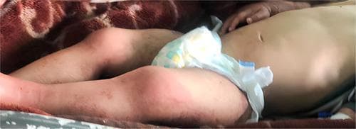 Clinical photograph of a 2-year-old child exhibiting dermatological and systemic manifestations of severe acute malnutrition (SAM). The image displays the torso and lower extremities of a pediatric patient with notable pallor. Significant pitting edema is visible in the lower limbs, particularly involving the legs and feet, giving the extremities a swollen, rounded appearance. The skin texture is markedly dry and xerotic with diffuse scaly areas. These cutaneous changes, including the scaly dermatosis and edema, are classic features of protein-energy malnutrition, specifically kwashiorkor or mixed-type SAM. The image also depicts a distended abdomen, which is frequently associated with underlying nutritional deficiencies, malabsorption syndromes like celiac disease, or hepatomegaly in malnourished populations. This visual serves as an educational reference for identifying the physical signs of severe nutritional failure and secondary skin disorders in a clinical pediatric setting.