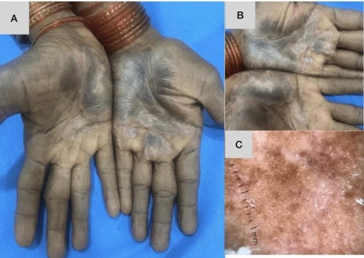 This composite educational image illustrates a case of chronic hand eczema with a clinical appearance mimicking palmoplantar psoriasis.
Panel A (Clinical Photograph) displays the palmar surfaces of both hands, showing bilaterally symmetrical, hyperkeratotic, and hyperpigmented patches. The lesions are primarily concentrated in the central palmar region and extend along the flexural creases of the fingers, exhibiting a thick, scaly texture on a background of skin darkening.
Panel B (Dermoscopic Image) provides a magnified view of the palmar skin, highlighting the texture and vascular alterations. It shows differentiated vascular structures, including linear and branched vessels, which are often found in psoriasiform eruptions.
Panel C (High-Magnification Dermoscopy) reveals a light red-to-brownish background with regularly spaced red dots and occasional globules. Fine, white powdery scaling is visible across the surface.
This case demonstrates the clinical and dermoscopic overlap between hyperkeratotic eczema and palmoplantar psoriasis, emphasizing the role of histopathology for definitive diagnosis in complex dermatological presentations.