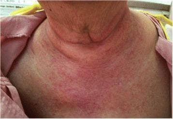 This clinical photograph displays the anterior neck, upper chest, and shoulders of a patient with dermatomyositis. The image highlights a confluent erythematous rash in a characteristic 'shawl sign' distribution. The skin appears mottled with varying intensities of redness, ranging from discrete maculopapular lesions to confluent patches covering the sun-exposed areas. A small, circular mark representing a recent skin punch biopsy site is visible on the upper left chest wall. This visual presentation is a hallmark cutaneous manifestation of inflammatory myopathies, illustrating the photosensitive nature of the condition. It serves as an educational example for dermatological and rheumatological assessment in patients presenting with symmetrical proximal muscle weakness and systemic symptoms.