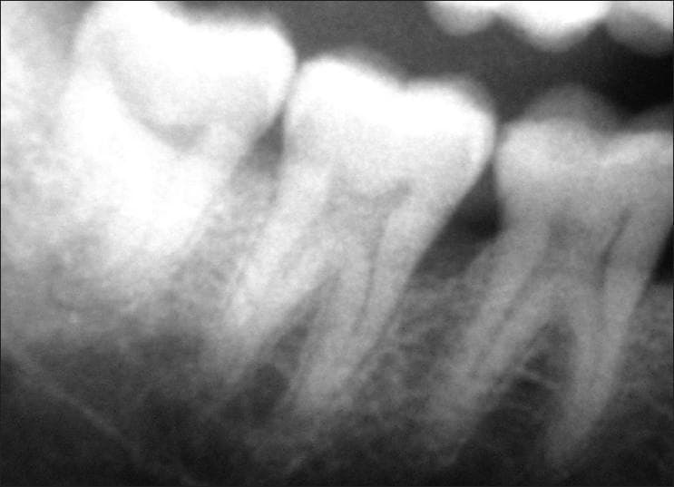 This diagnostic intraoral radiograph (periapical view) illustrates different patterns of periodontal alveolar bone loss in the mandibular right molar region. The image focuses on teeth 46 (first molar) and 47 (second molar). Adjacent to tooth 46, the alveolar bone crest exhibits a horizontal bone loss pattern, characterized by a relatively flat, horizontal reduction in bone height parallel to the cementoenamel junction (CEJ) of adjacent teeth. In contrast, the distal aspect of tooth 47 demonstrates a vertical (angular) bone loss pattern, where the bone defect forms an oblique angle relative to the root surface, creating an intrabony pocket. The radiographic appearance highlights key diagnostic criteria for periodontitis staging, showing the distinction between generalized crestal height reduction and localized vertical osseous defects. Such imaging is critical in dental education for clinical decision-making regarding non-surgical vs. regenerative surgical periodontal therapies.