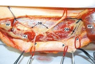This clinical photograph of a cadaveric dissection illustrates the vascular anatomy of the anterolateral thigh, specifically relating to the design and elevation of an anterolateral thigh (ALT) flap. The image identifies the vastus lateralis (VL) and the rectus femoris (RF) muscles, with the RF being partially cut to expose the underlying pedicle. Labeled anatomical structures include the descending branch (DB) and the oblique branch (OB) of the lateral circumflex femoral artery. Multiple perforators (P) are shown originating from both the descending and oblique branches, which are critical for providing the blood supply to the overlying skin and fascia in flap surgery. The vessels are highlighted with red vessel loops for clarity. This anatomical study demonstrates variation in perforator origin, serving as an educational resource for plastic and reconstructive surgeons to understand the different vascular patterns encountered during flap harvest to ensure tissue viability.