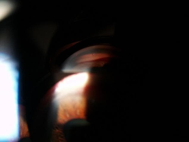 This clinical photograph displays a gonioscopy procedure focused on the anterior chamber angle of a human eye. The image captures a slit-lamp view through a goniolens, where a concentrated beam of light illuminates a segment of the iridocorneal angle. Within the illuminated region, the iris surface is visible, showing a reddish-brown color and granular texture. Critical findings include the presence of neovascularization, characterized by fine, irregular, and abnormal blood vessels traversing the iris and potentially extending into the trabecular meshwork. This presentation is indicative of neovascular glaucoma or rubeosis iridis. The surrounding area is primarily dark, creating a high-contrast view that highlights the anatomical landmarks such as the iris root and the angle structures. This visual is significant for illustrating secondary ocular manifestations of systemic ischemic conditions, such as diabetic retinopathy or central retinal vein occlusion, which lead to pathological angiogenesis in the anterior segment.