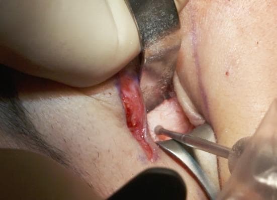 This clinical photograph captures an intraoperative view of a surgical procedure involving the lateral orbital rim. A surgical incision has been made through the skin and orbicularis muscle near the lateral canthus, with the surrounding skin marked by purple surgical ink. The surgical field is exposed using a metal retractor to provide visualization of the underlying bone. A surgical drill with a small round burr is being used to create a burr hole (identified as hole n°4) in the lateral orbital rim, just below the level of the lateral canthus. The procedure illustrates a key step in a concentric malar lift or canthopexy, where bone anchoring points are established for suture fixation. The image demonstrates the precise handling of specialized surgical instruments and the subperiosteal exposure required for mid-face rejuvenation and lower eyelid stabilization.